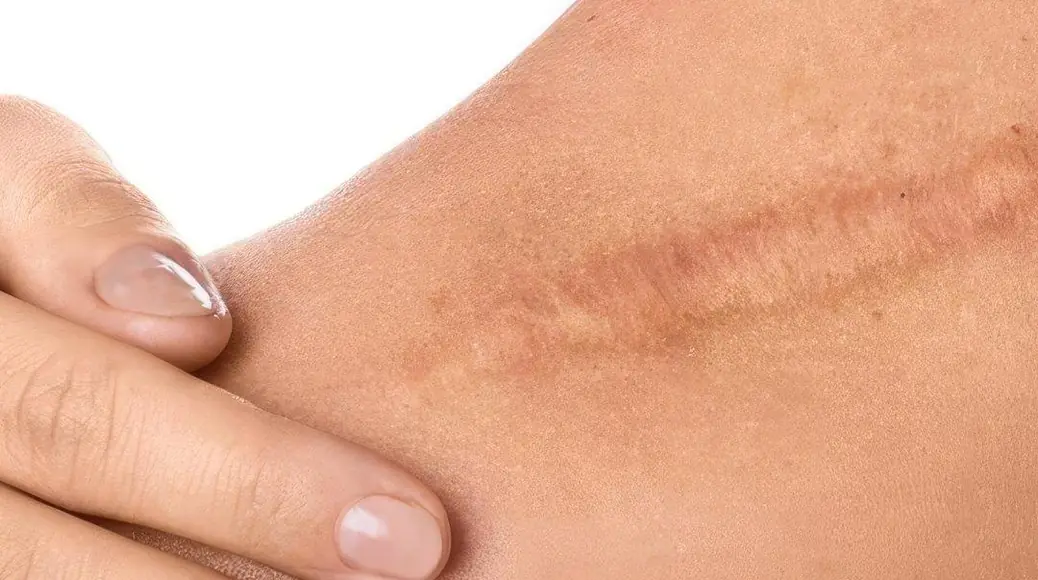 A healed scar on an arm, touched by a hand